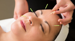 Cosmetic Acupuncture