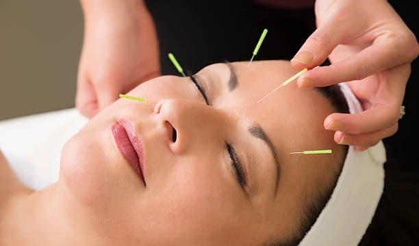 Cosmetic Acupuncture